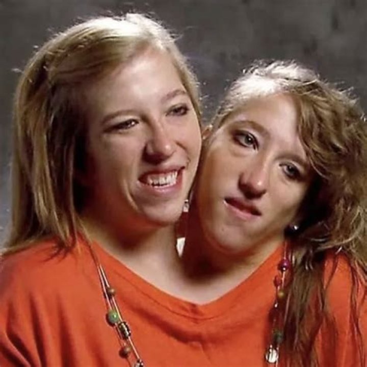 Understanding Abby and Brittany Hensel: The Inspiring Journey of Conjoined Twins