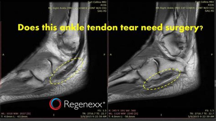 Can tendons heal naturally?