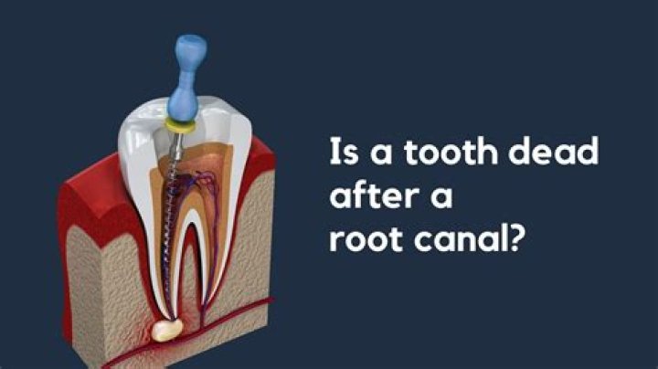 Can you pull a tooth that had a root canal?