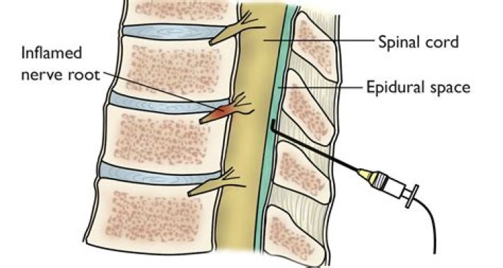 Does injection help spinal stenosis?