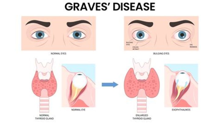 How do you know if you have Graves eye disease?