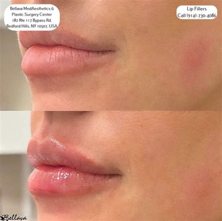 Is lip lift better than filler?