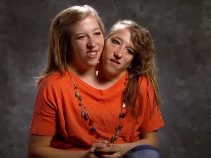 Now Abby and Brittany Hensel: The Unique Journey of Conjoined Twins