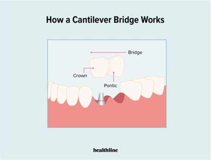 What is a cantilever dental bridge?