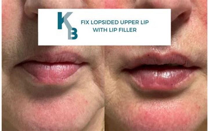 What is lip border filler?
