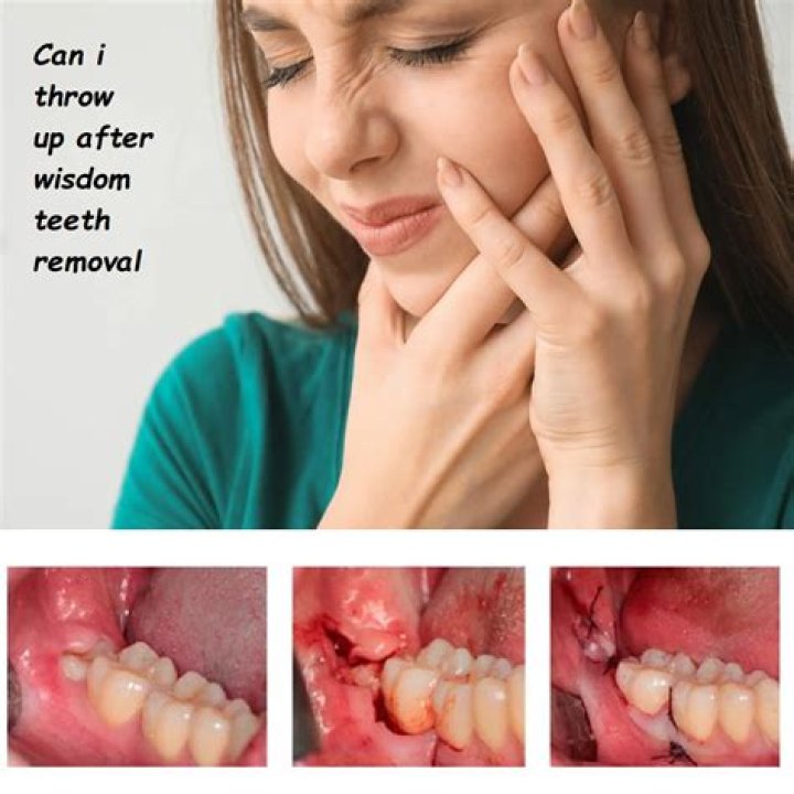 When can I sneeze after wisdom teeth removal?