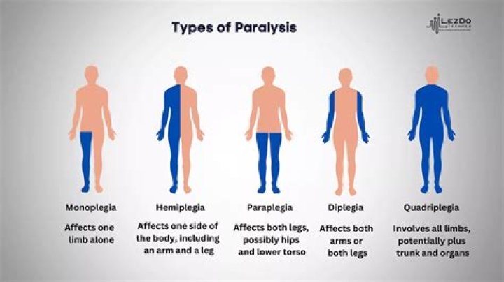 Which medicine can cause permanent paralysis?
