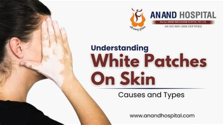 Why are white patches on skin?